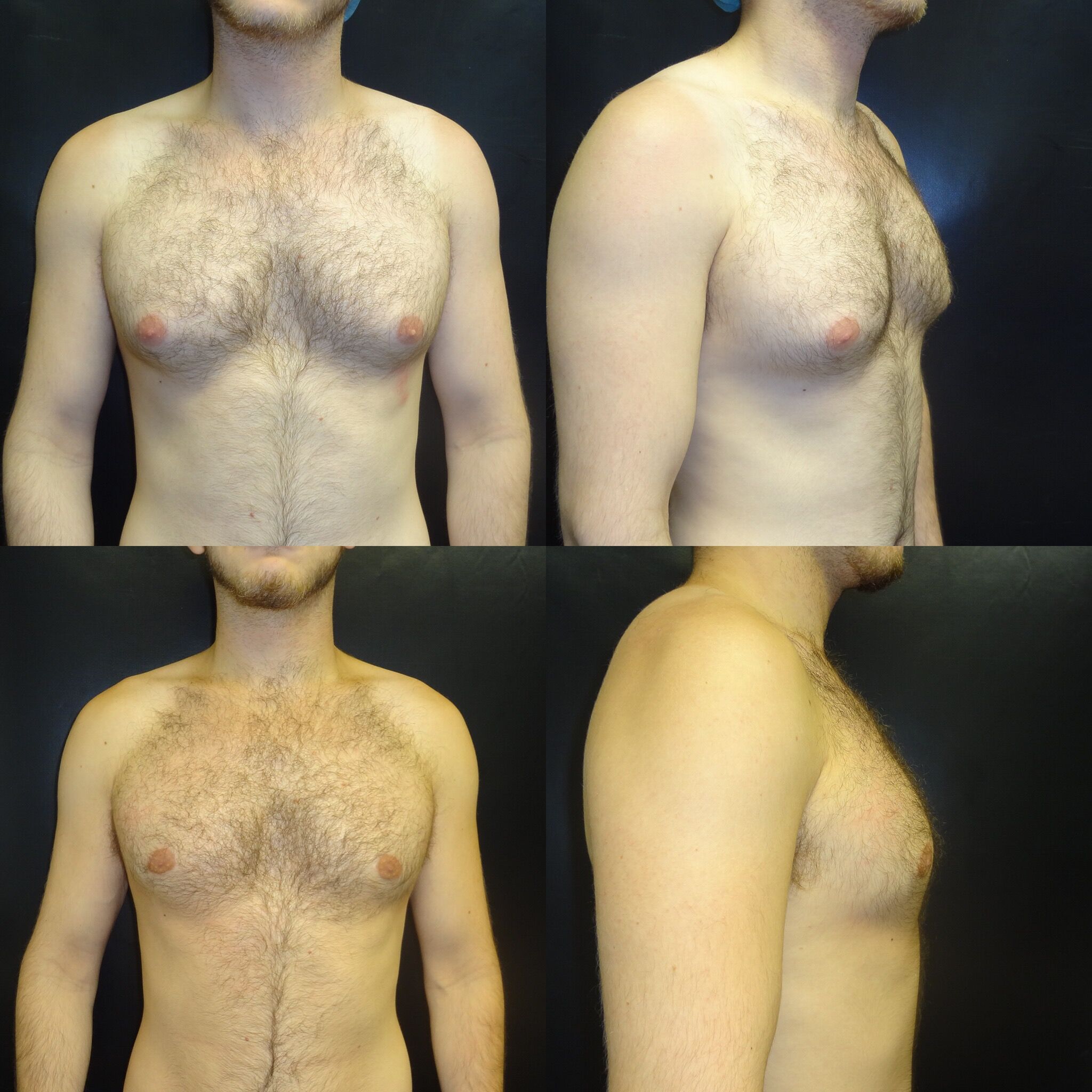 Chest-Before-After