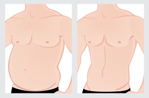 Tummy Tuck Terminology Manhattan