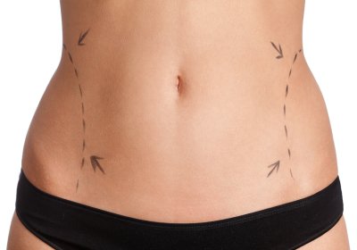 What to Expect from Liposuction New York