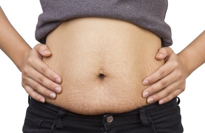 What to Expect from a Tummy Tuck Manhattan