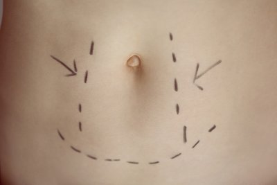 Which Type of Tummy Tuck Is Right for You? Manhattan