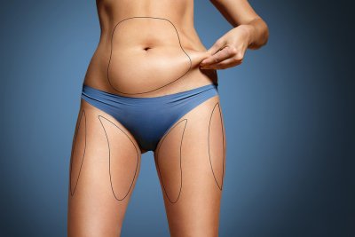 liposuction manhattan