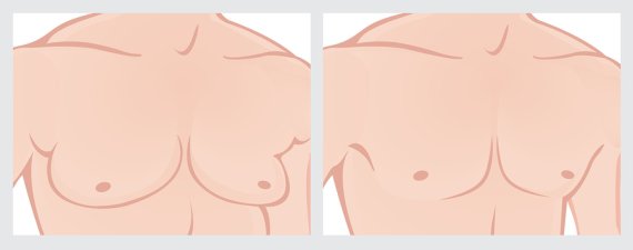 gynecomastia man boobs NYC
