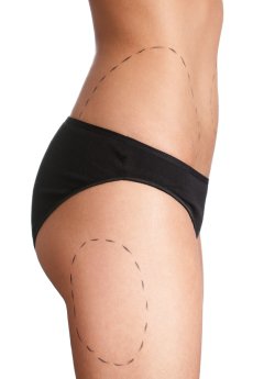 liposuction in NYC