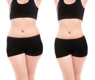 liposuction procedure facts NYC