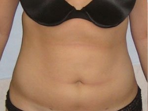 types of liposuction